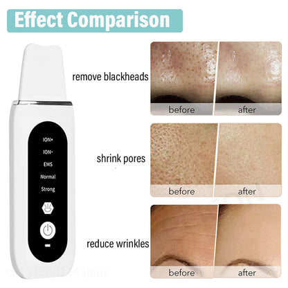 Blackhead Remover and Deep Cleansing Tool for Clearer Skin